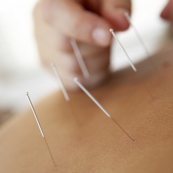 Acupuncture