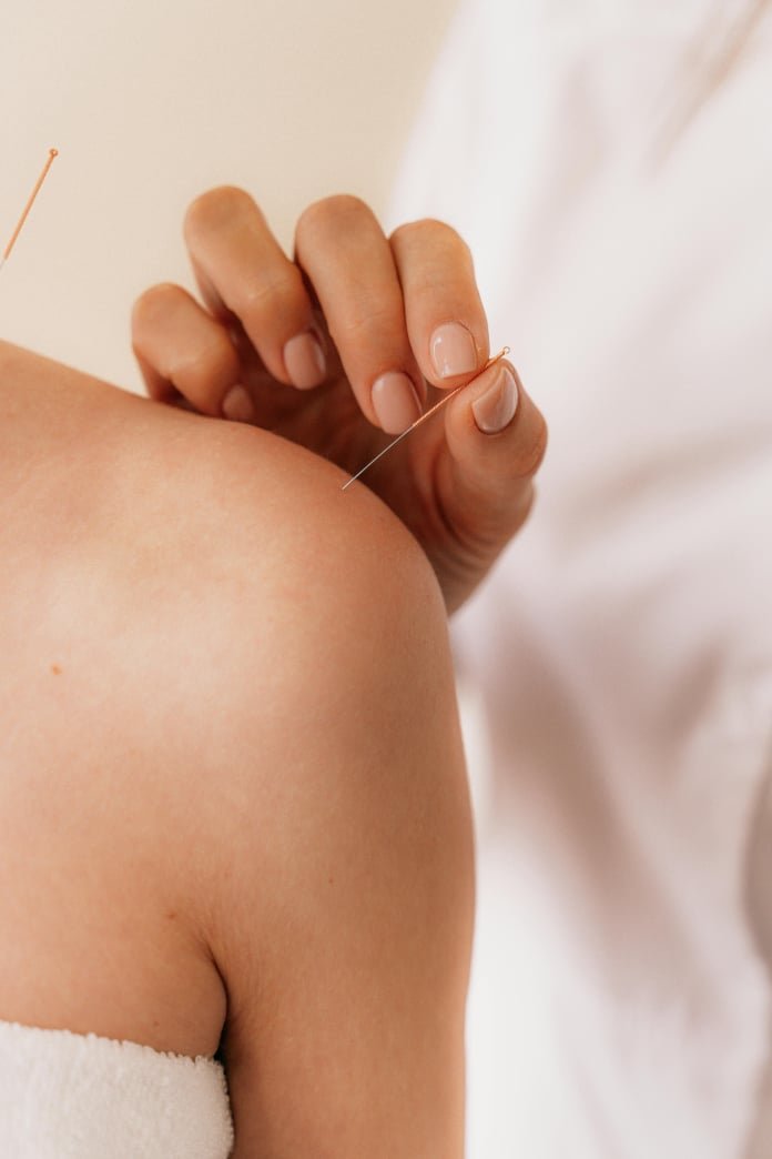 Acupunture